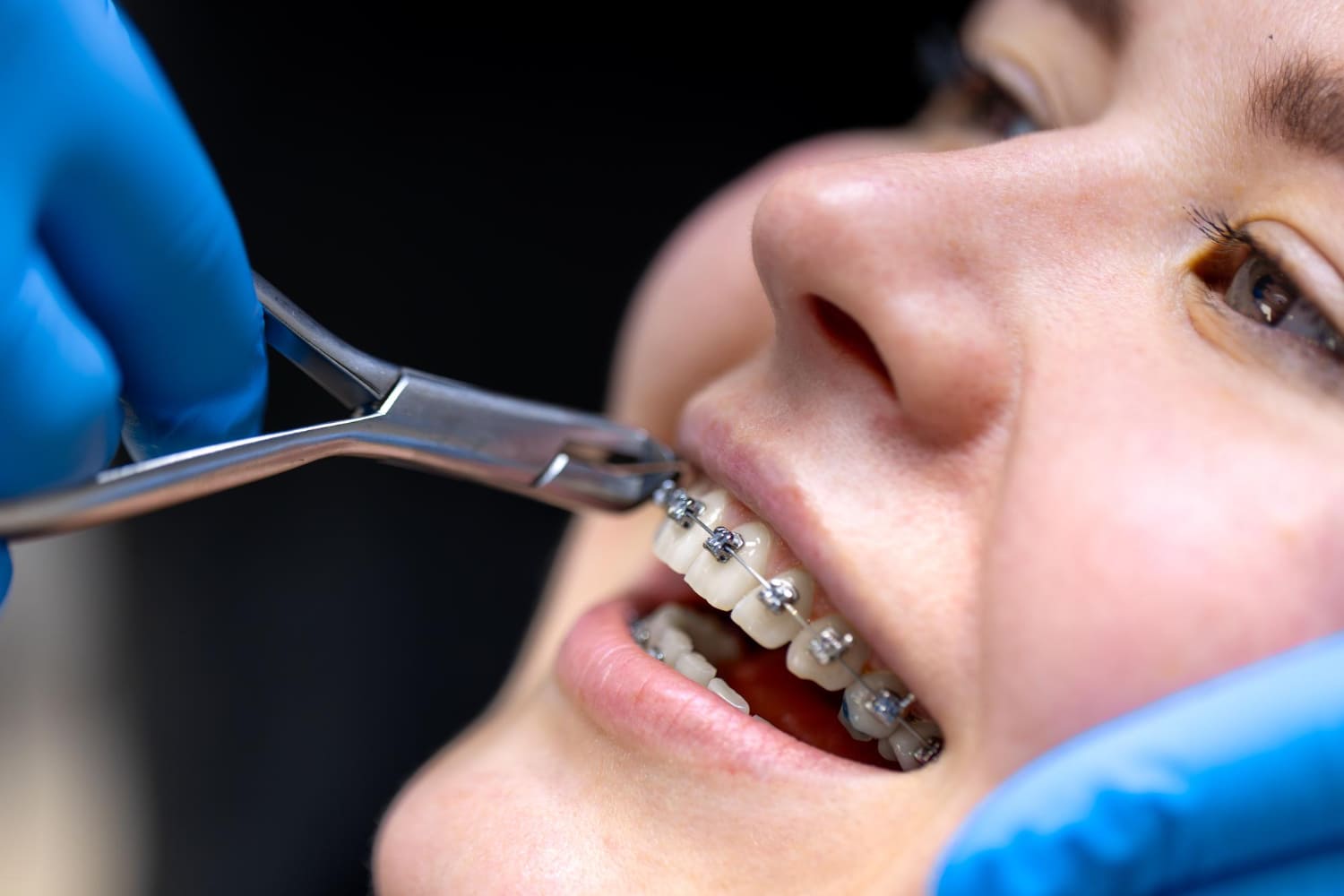 Orthodontic treatment with ceramic braces