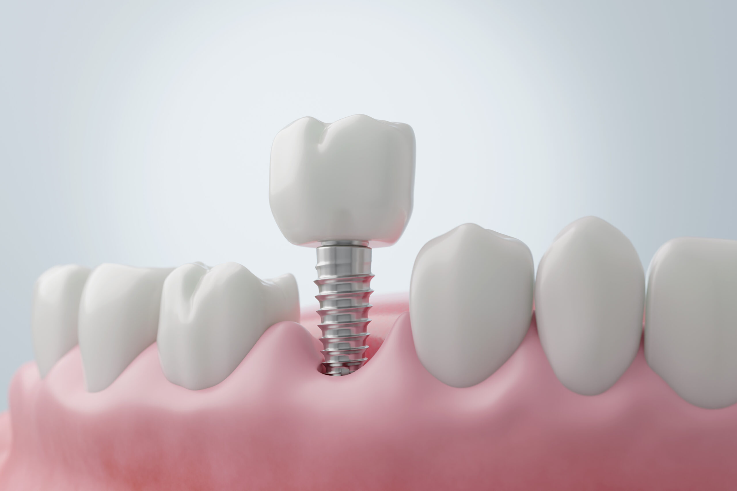 Dental implant consultation and restorative dental care